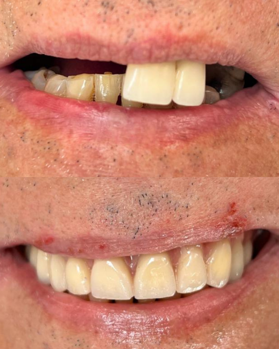 Resultado de tratamento odontológico 1 na Sorrifácil Viamão