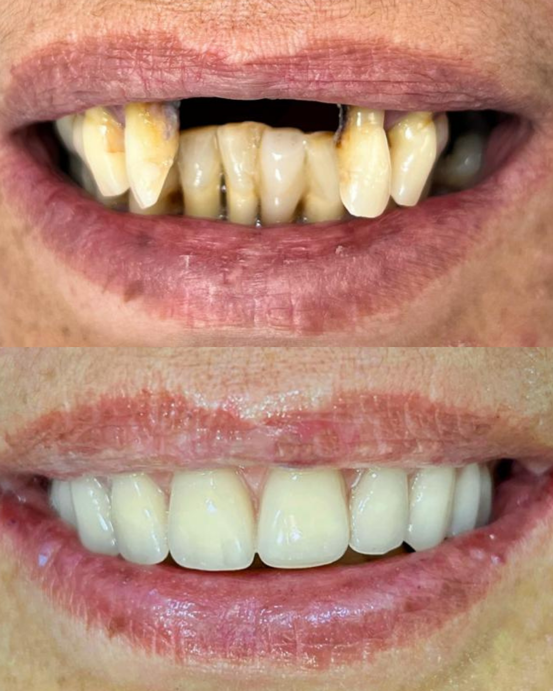 Resultado de tratamento odontológico 3 na Sorrifácil Viamão