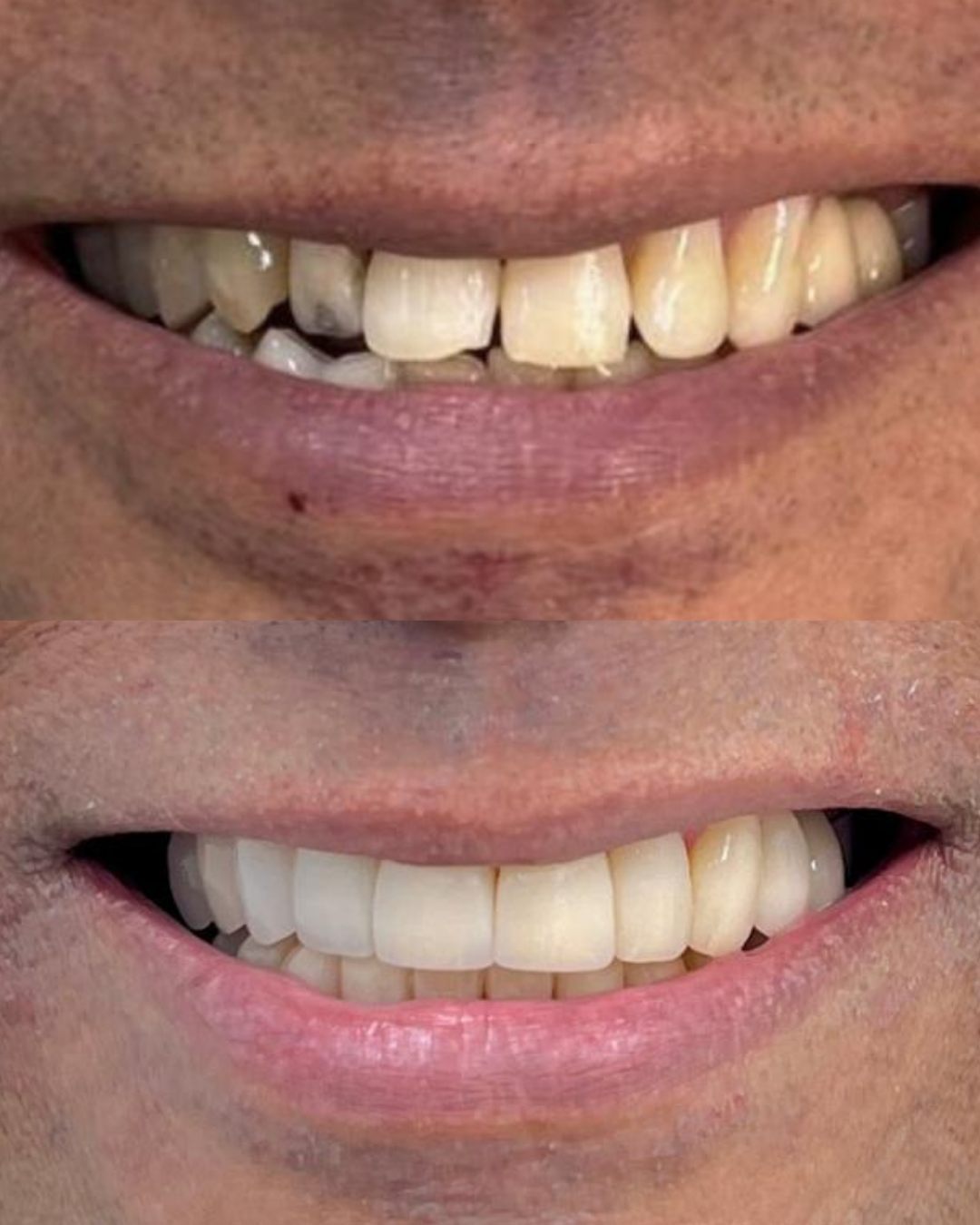 Resultado de tratamento odontológico 2 na Sorrifácil Viamão